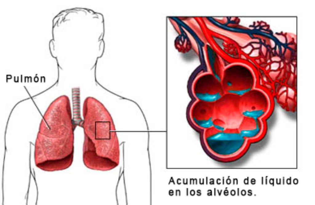 Signos de edema pulmonar de altura