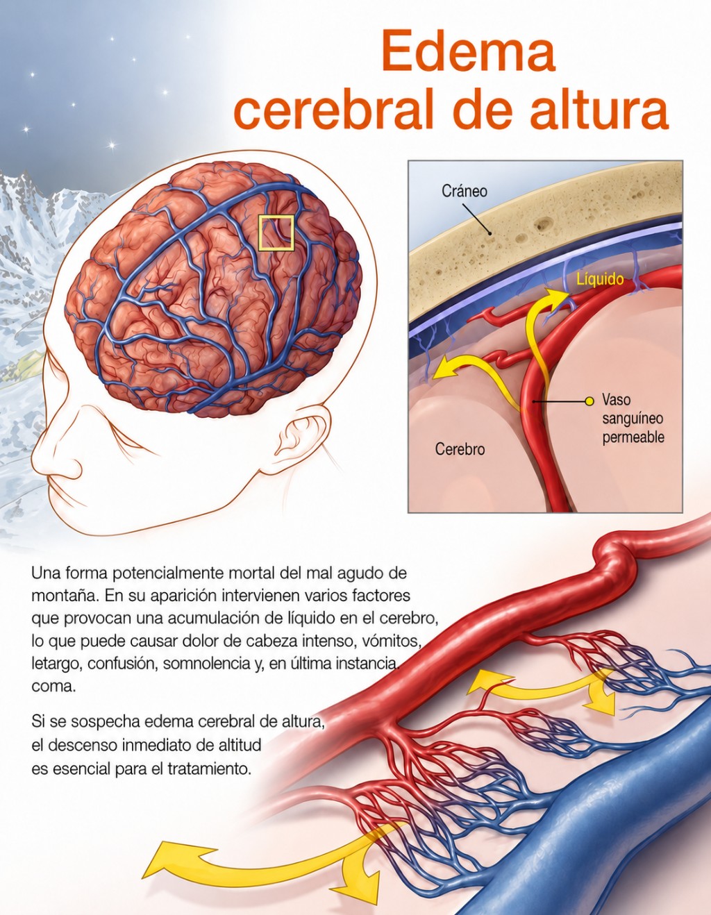 Signos de edema cerebral de altura