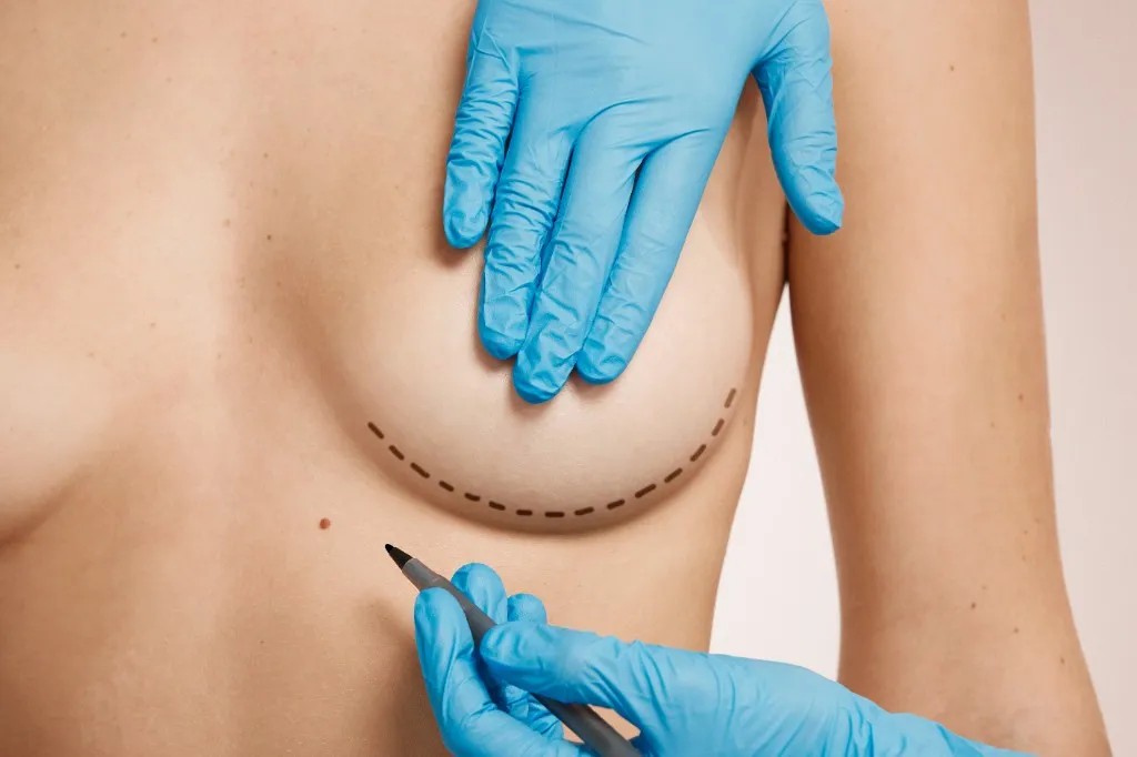 Implantes Mamarios: cómo elegir la mejor técnica para ti | Dr. Puello