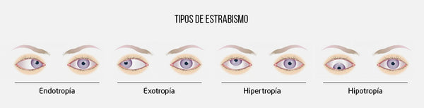 Tipos de estrabismo