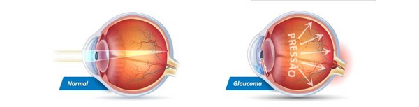 glaucoma infantil 01