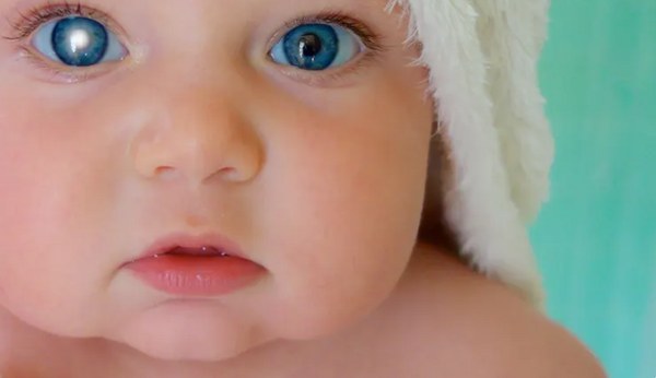 glaucoma infantil
