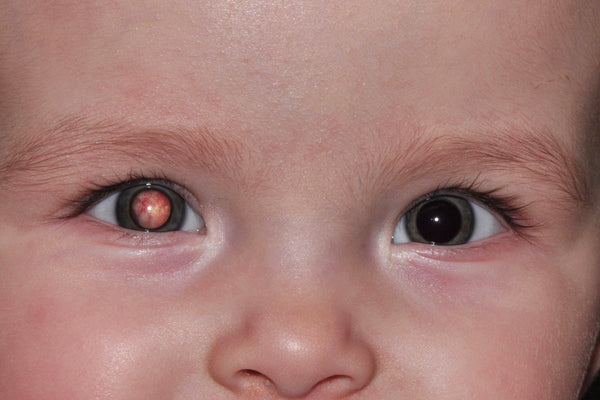 retinoblastoma infantil