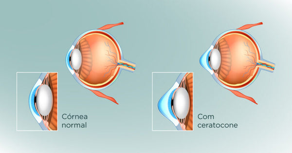 ceratocone: o que é?