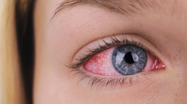 olhos vermelhos ceratocone