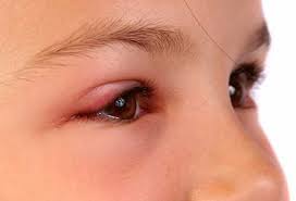 Alergia nos olhos - o que fazer?