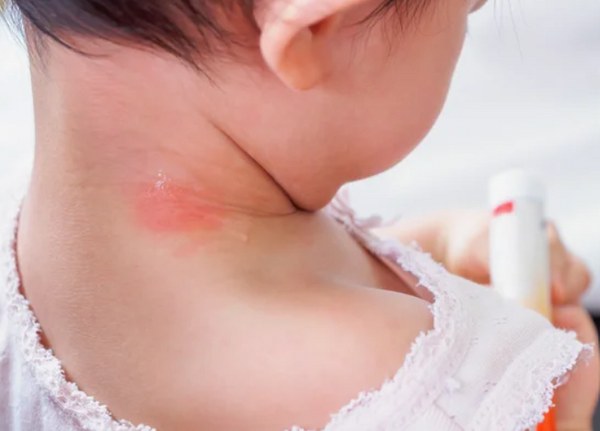 Alergias alimentares em crianças