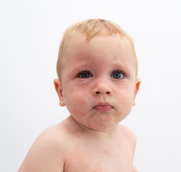 bebê com alergia ocular