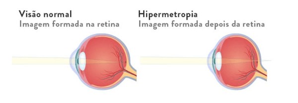 hipermetropia infantil