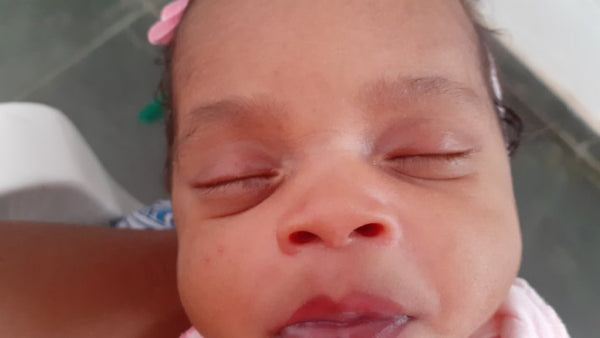 bebê com a pálpebra inchada