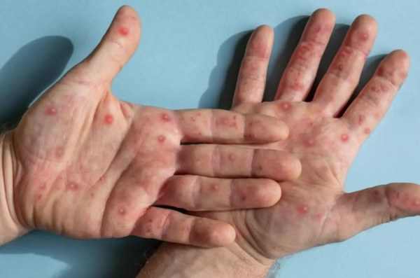mpox em crianças