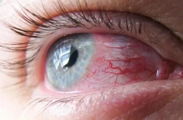 trombose ocular - entenda o que é