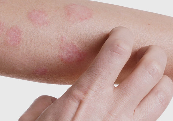 Dermatite atópica em crianças: Tudo que você precisa saber