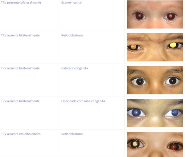 como o flash pode detectar doenças oculares?