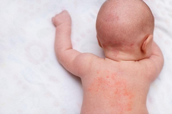 Brotoejas no bebê: Tratamentos caseiros, causas e sintomas